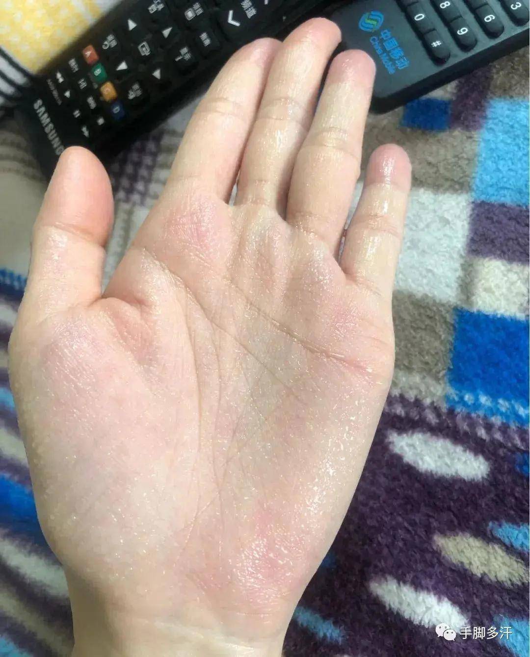 最新代偿性出汗治疗，重塑舒适生活的关键之道