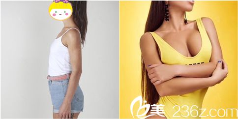 曼托隆胸价格概述