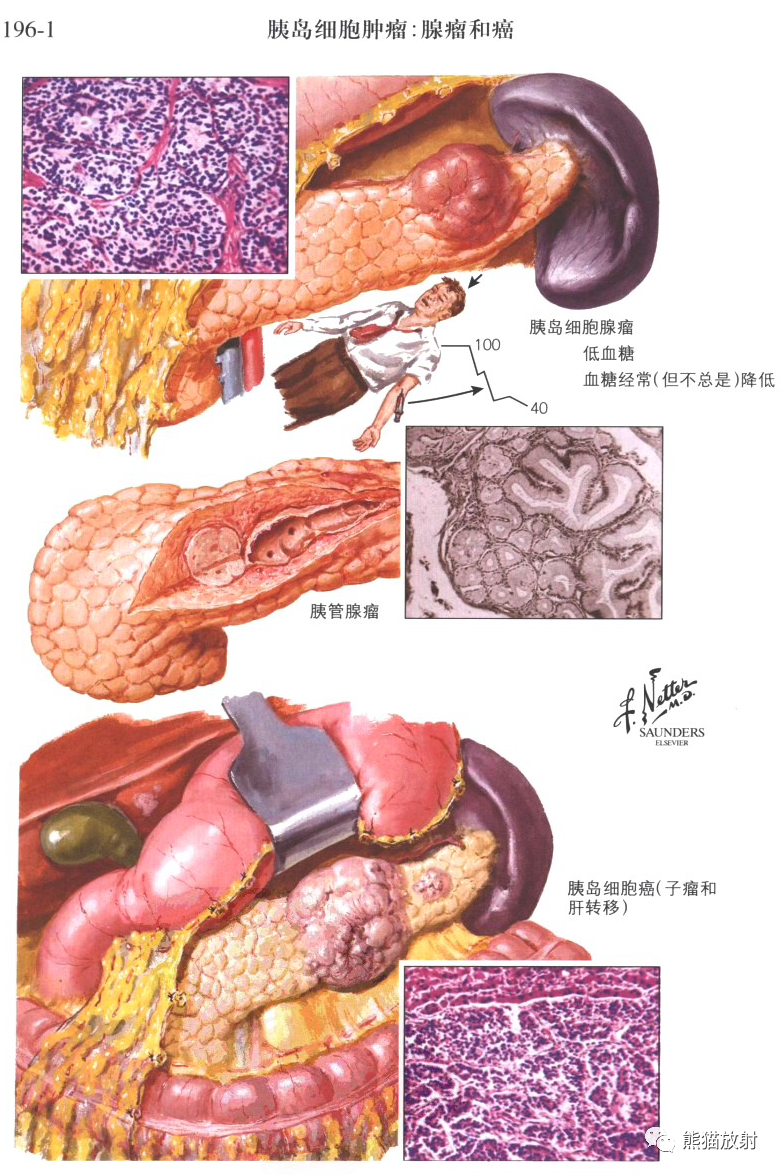 胰腺肿瘤最新研究进展与治疗突破概览